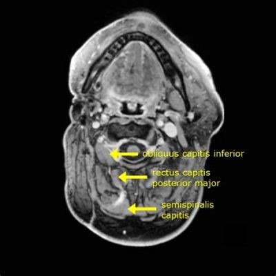 Does Occipital Neuralgia Show Up on MRI? Exploring the Invisible Pain and Its Mysteries